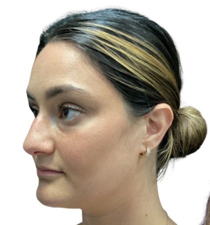 Rhinoplasty Before & After Patient #21223