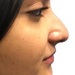 Rhinoplasty Before & After Patient #21226