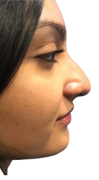 Rhinoplasty Before & After Patient #21226