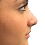 Rhinoplasty Before & After Patient #21226