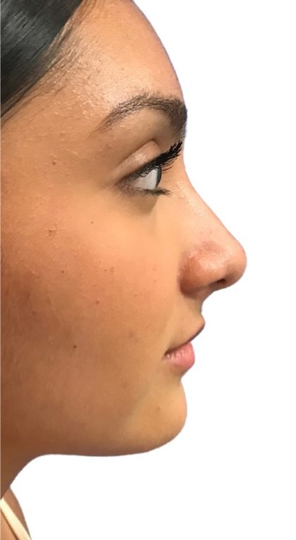 Rhinoplasty Before & After Patient #21226