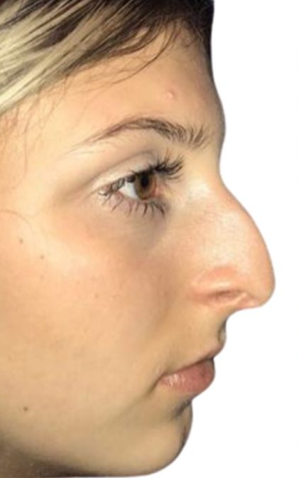 Rhinoplasty Before & After Patient #21225