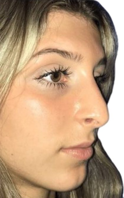 Rhinoplasty Before & After Patient #21225