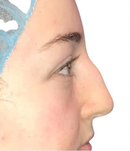 Rhinoplasty Before & After Patient #21228