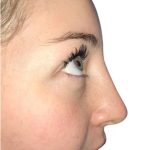 Rhinoplasty Before & After Patient #21228