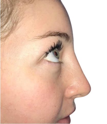 Rhinoplasty Before & After Patient #21228
