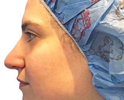 Rhinoplasty Before & After Patient #21224