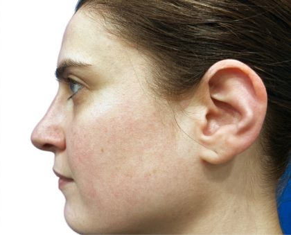 Rhinoplasty Before & After Patient #21224