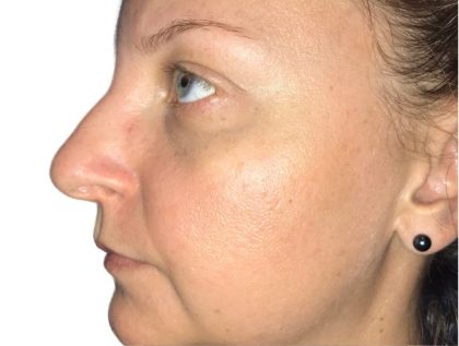 Rhinoplasty Before & After Patient #21205