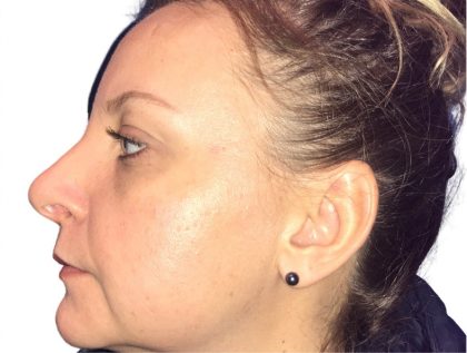 Rhinoplasty Before & After Patient #21205