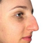 Rhinoplasty Before & After Patient #21233