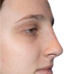 Rhinoplasty Before & After Patient #21233