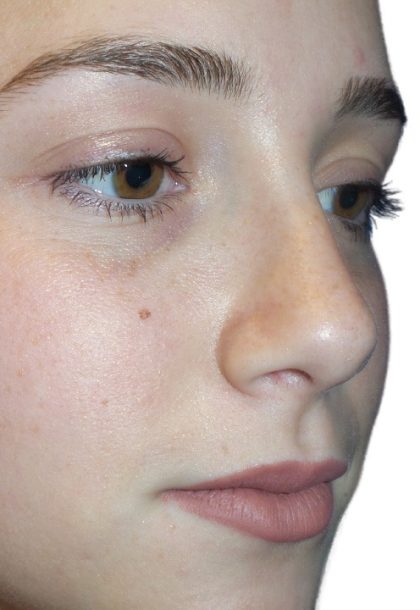 Rhinoplasty Before & After Patient #21234