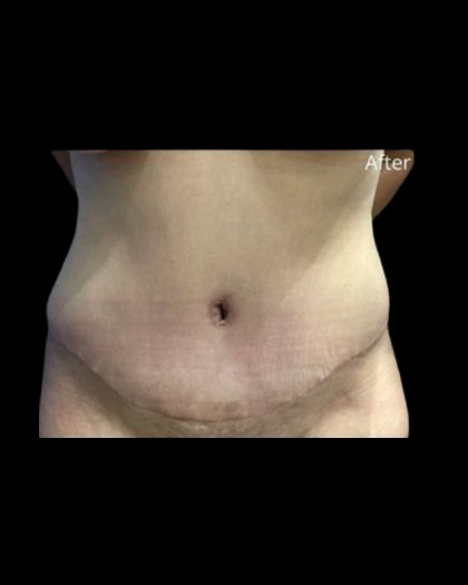 Tummy Tuck Before & After Patient #21259