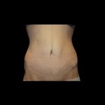 Tummy Tuck Before & After Patient #21277