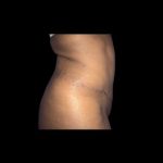 Tummy Tuck Before & After Patient #21272