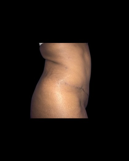 Tummy Tuck Before & After Patient #21272