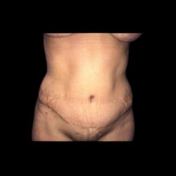 Tummy Tuck Before & After Patient #21281