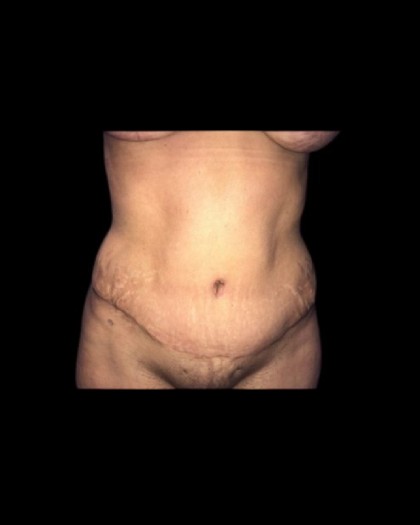 Tummy Tuck Before & After Patient #21281