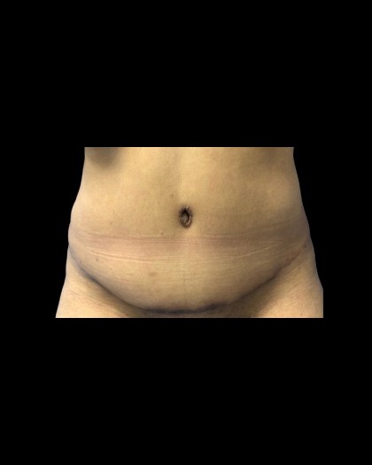 Tummy Tuck Before & After Patient #21265