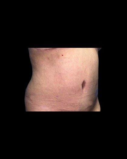 Tummy Tuck Before & After Patient #21260