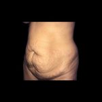 Tummy Tuck Before & After Patient #21281