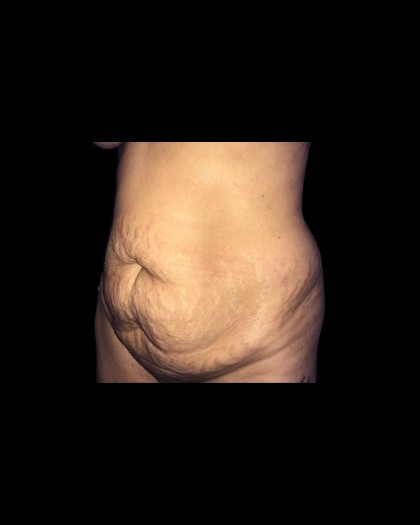 Tummy Tuck Before & After Patient #21281