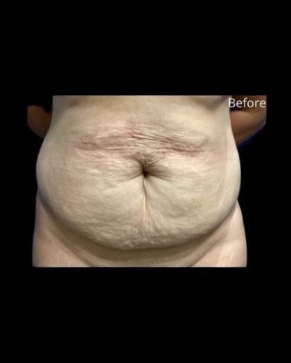 Tummy Tuck Before & After Patient #21259