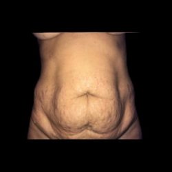 Tummy Tuck Before & After Patient #21281