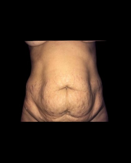 Tummy Tuck Before & After Patient #21281