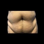 Tummy Tuck Before & After Patient #21265
