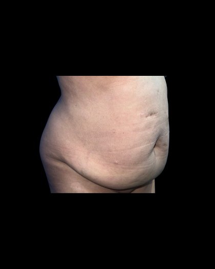 Tummy Tuck Before & After Patient #21260