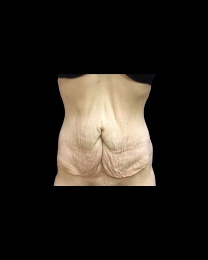 Tummy Tuck Before & After Patient #21277
