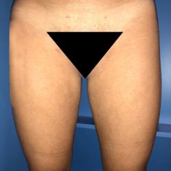 Liposuction Before & After Patient #21100