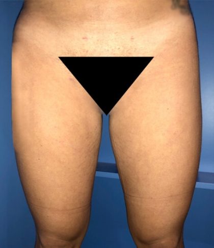 Liposuction Before & After Patient #21100