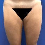 Liposuction Before & After Patient #21100