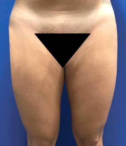 Liposuction Before & After Patient #21100