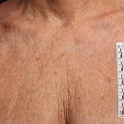 Ultherapy Chest Before & After Patient #21185