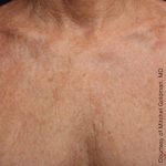 Ultherapy Chest Before & After Patient #21185