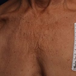 Ultherapy Chest Before & After Patient #21186