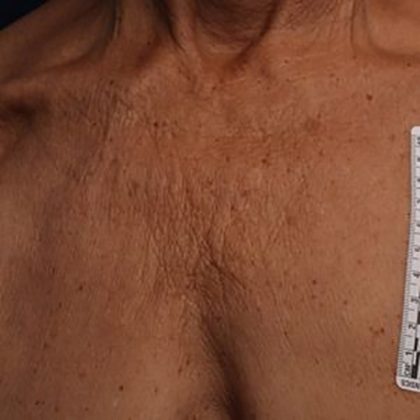 Ultherapy Chest Before & After Patient #21186