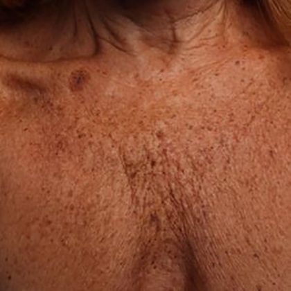 Ultherapy Chest Before & After Patient #21187
