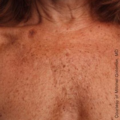 Ultherapy Chest Before & After Patient #21187