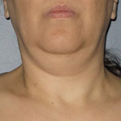 Ultherapy Face Before & After Patient #21195