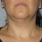 Ultherapy Face Before & After Patient #21195