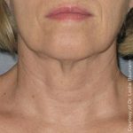Ultherapy Face Before & After Patient #21197