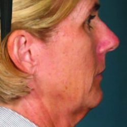 Ultherapy Face Before & After Patient #21207