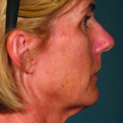 Ultherapy Face Before & After Patient #21207