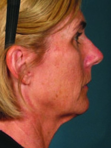 Ultherapy Face Before & After Patient #21207