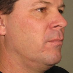 Ultherapy Face Before & After Patient #21208